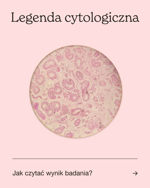 W nowym programie profilaktyki raka szyjki macicy cytologia płynna (LBC) jest wykonywana u kobiet z dodatnim wynikiem testu HPV.

 🔍 Jakie komórki ocenia się w cytologii? Szyjka macicy zbudowana jest z dwóch rodzajów nabłonka:

płaskiego – od strony pochwy (to z niego najczęściej rozwija się rak szyjki),

gruczołowego – wewnątrz kanału szyjki (rzadziej ulega transformacji nowotworowej).

 Wyniki cytologii – system Bethesda

(uproszczona interpretacja, zawsze omawiaj wynik cytologii ze swoim ginekologiem)

 NILM – brak nieprawidłowych komórek, wynik prawidłowy. 🟢

 ASC-US – komórki płaskonabłonkowe wyglądają nietypowo, ale nie spełniają kryteriów zmian dysplastycznych. Najczęstsza nieprawidłowość, może wynikać np. z infekcji lub stanu zapalnego. 🟡

ASC-H – komórki płaskonabłonkowe wyglądają nietypowo i nie można wykluczyć HSIL. 🟠

LSIL – łagodna dysplazja komórek płaskonabłonkowych, cechy wczesnej transformacji nowotworowej. U 60% kobiet ustępuje samoistnie w ciągu roku, u 90% w ciągu 3 lat. 🟠

HSIL – bardziej zaawansowana dysplazja komórek płaskonabłonkowych, możliwy rak. 🔴

AGC – komórki gruczołowe wyglądają nietypowo. 🟠

AG-US – komórki gruczołowe wyglądają nietypowo, ale nie spełniają kryteriów zmian dysplastycznych. 🟠

AGC-N – komórki gruczołowe wyglądają nietypowo, z cechami sugerującymi raka. 🔴

 Legenda:

🟢 Kolejne badanie w wyznaczonym czasie.

🟡 Zalecana kontrola.

🟠 Wymaga dalszej diagnostyki.

🔴 Wymaga pilnej diagnostyki.

 👩‍⚕️👨‍⚕️ Nieprawidłowości w cytologii nie oznaczają od razu raka, ale zawsze wymagają indywidualnej oceny. Lekarz może skierować Cię na dalszą diagnostykę – więcej na ten temat już wkrótce!

Autorka: lek. Magdalena Miłobędzka

Redakcja: lek. Magdalena Fronczek, prof. dr hab. n. med. Wojciech Szczeklik