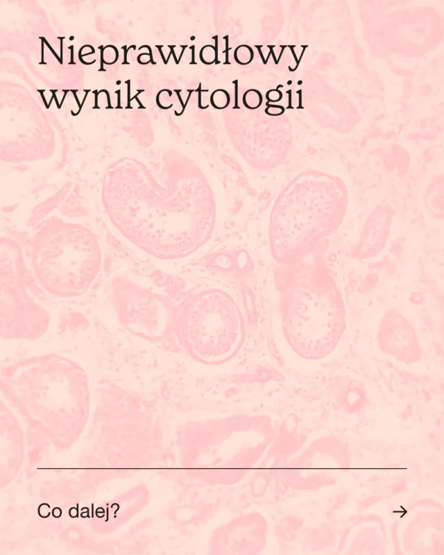 🔬 Nieprawidłowy wynik cytologii nie musi oznaczać raka, ale często wiąże się z koniecznością dalszej diagnostyki, aby dokładnie ocenić charakter wykrytych zmian.
‌
❓Jak rozwija się nowotwór?
Proces zwykle rozpoczyna się od tzw. dysplazji – specyficznych nieprawidłowości w budowie komórek.
‌
Zmiany te czasem ustępują samoistnie, ale mogą też postępować i prowadzić do rozwoju raka.
‌
❗ Im wyższy stopień dysplazji, tym większe ryzyko przekształcenia w nowotwór.
🔍 Co dalej po nieprawidłowym wyniku cytologii?
Lekarz może skierować pacjentkę na dalsze badania:
➡️ Kolposkopia – ocena szyjki macicy pod powiększeniem, często z użyciem odczynników uwidaczniających zmiany.
➡️ Biopsja szyjki macicy – pobranie fragmentu tkanki do badania mikroskopowego, zwykle podczas kolposkopii.
➡️ Konizacja szyjki macicy – usunięcie stożkowatego fragmentu szyjki macicy w celach diagnostycznych i/lub terapeutycznych; może być wykonana w trakcie kolposkopii.
➡️ Wyłyżeczkowanie kanału szyjki macicy – pobranie materiału (wyskrobin) z wnętrza kanału szyjki; może towarzyszyć biopsji lub konizacji.
‌
📋 Jak interpretować wyniki histopatologiczne?
‌
CIN1 – dysplazja 1. stopnia, wczesny stan przedrakowy.
Ustępuje samoistnie u ~60% kobiet.
CIN2 – dysplazja 2. stopnia, stan przedrakowy.
Ustępuje samoistnie u ~40% kobiet.
CIN3 – dysplazja 3. stopnia, zaawansowany stan przedrakowy.
Wysokie ryzyko progresji do raka.
CIS (carcinoma in situ) – bardzo wczesna forma raka, ograniczona do jednej lokalizacji.
To już rak, ale rokowanie jest nadal bardzo dobre.
‌
🩷 Zadbaj o zdrowie i weź udział w programie profilaktyki raka szyjki macicy!

Autorka: lek. Magdalena Miłobędzka
Redakcja: lek. Magdalena Fronczek, prof. dr hab. n. med. Wojciech Szczeklik